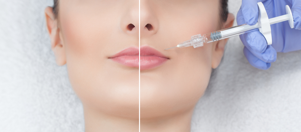 harmonizacao facial 1
