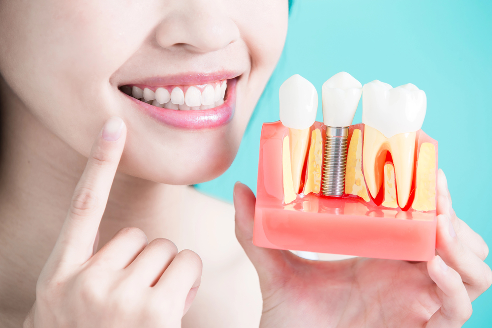 Quais os benefícios do implante dentário? 3 Implantodontia 2