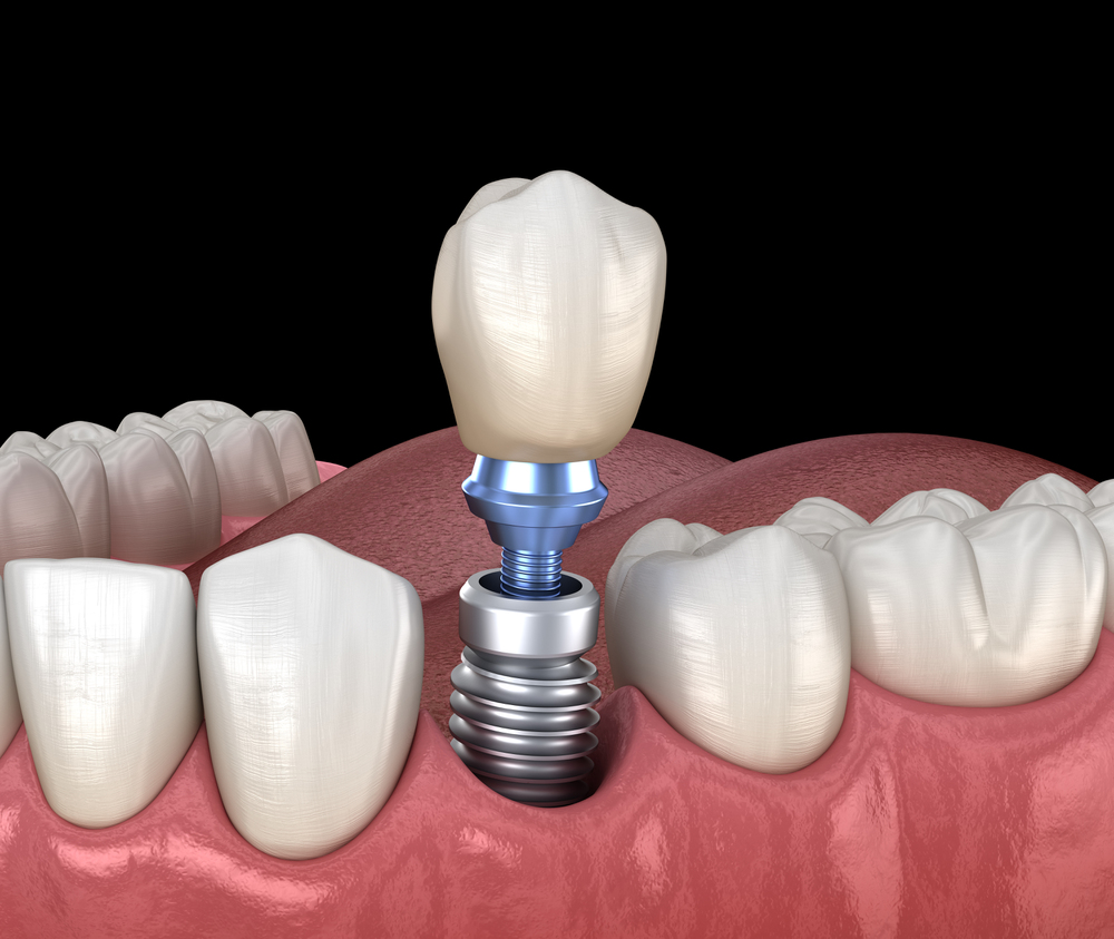 Quais os benefícios do implante dentário? 2 Implantodontia